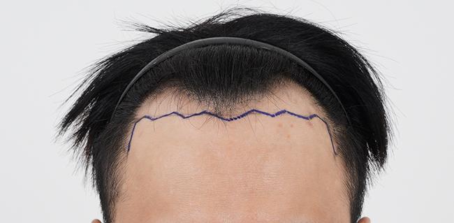 M字鼻切開3600本も手術して、もう暗黒期が始まりますね（モモ整形外科3週目）