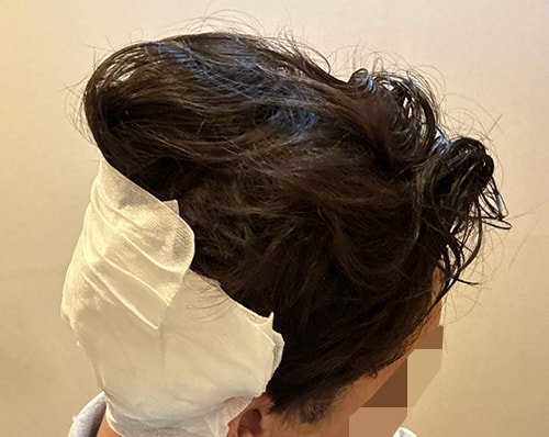 7- 수술끝나면 뒤에 이렇게 붕대하고 비니 씌워줍니다.jpg