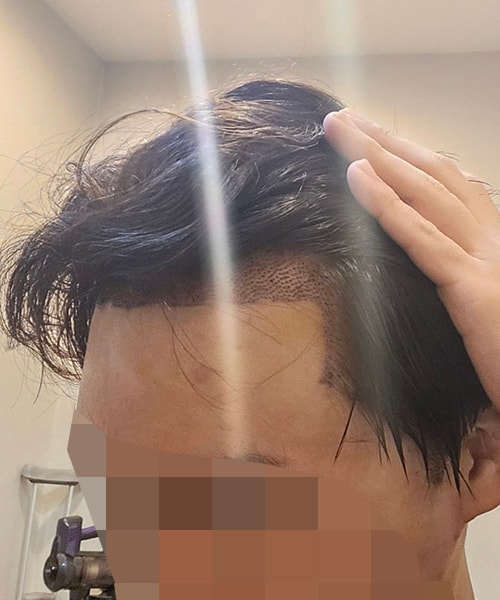 8-수술다음날 샴푸받고 찍어봤네요.jpg