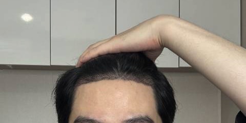 2- 2주 각질샴푸 받고 찍어 봤습니다.jpg