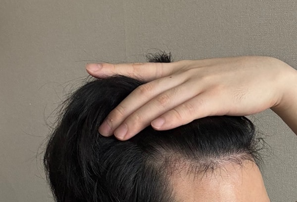 3. 암흑기는 마음비우라는데 계속 신경쓰여서 거울만 보게됩니다.jpg