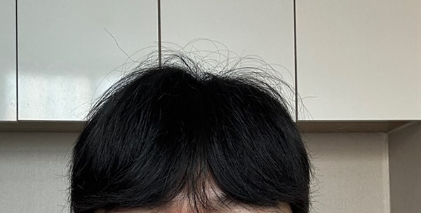 5. 2주차까진 짧지만 채워져보여서 이마 까고 다녔는데 많이 털려서 머리내리고 다닙니다 오늘 주사 맞아서 주말에 머리 자르려구요.jpg