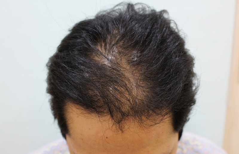 12 Months of Surgery to Feel Awesome (Gather up with full/frontal hair!)