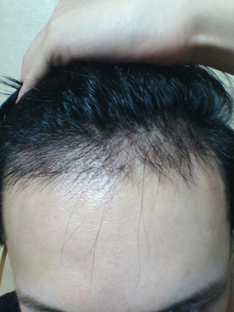 수술후 2주 (2).jpg