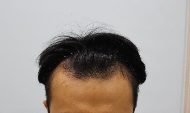 真医生，切开，3800，3个月，请评价