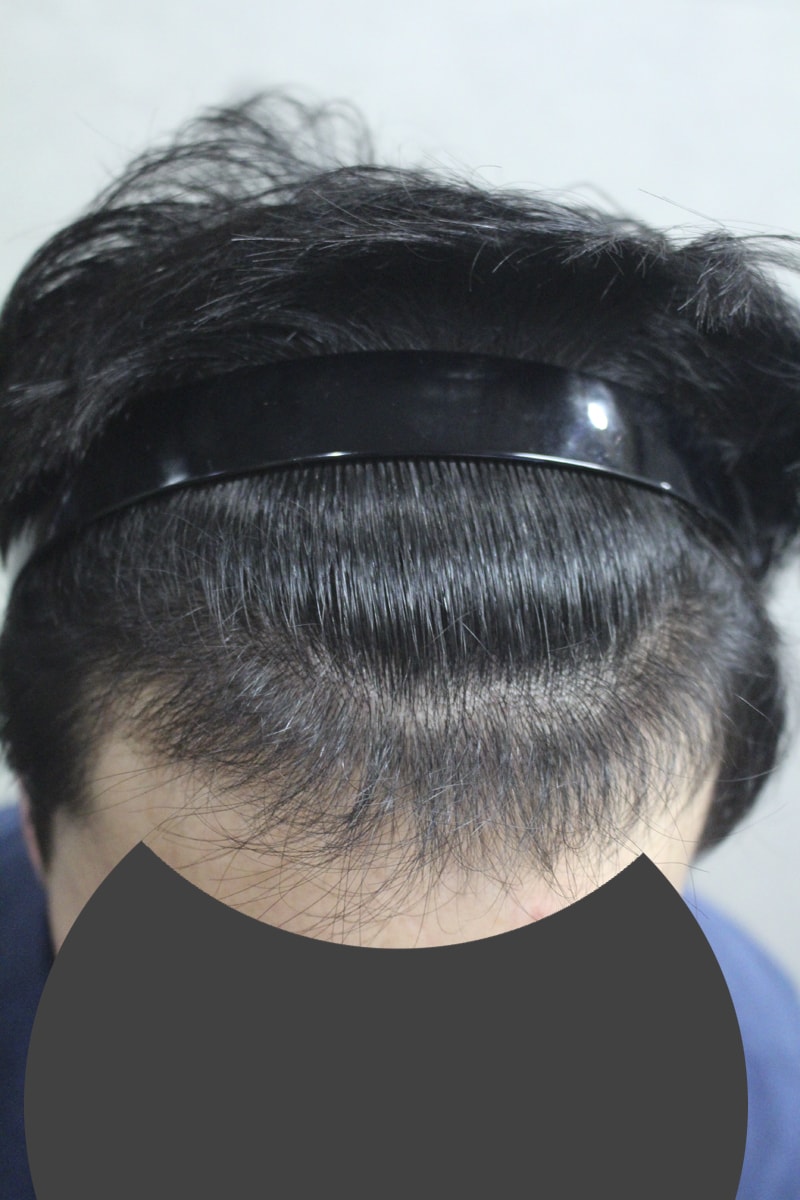It's been more than five months since I transplanted 2,300 hair~~~
