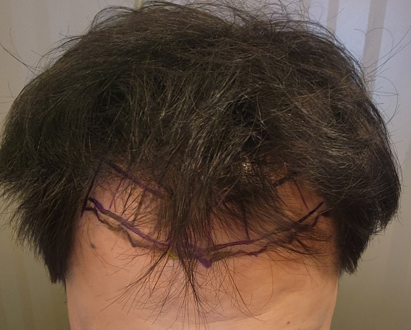 뉴헤어 절개식 2000모낭 수술후기