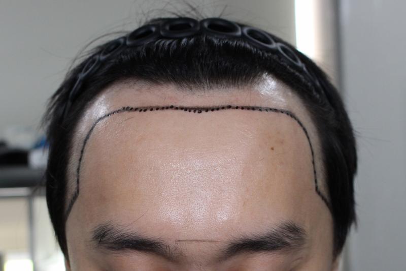 이식전.jpg