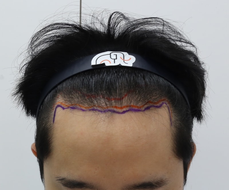 압구정 맘모스에서 비절개 모발이식 10개월 경과 후기입니다!