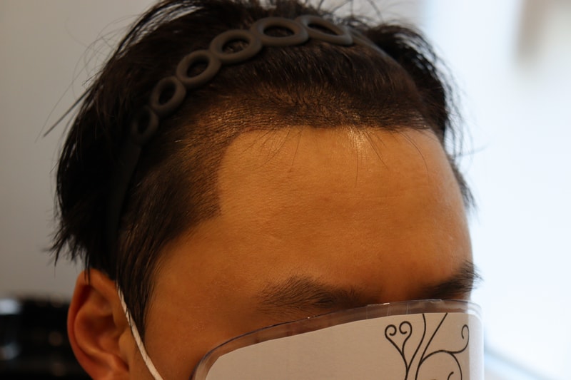 수술 후 2주차 사진측면.jpg
