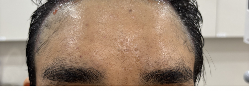 Daegu Momo Clinic Director Kang Dong-woo's non-cut microcut 2,600mo+@