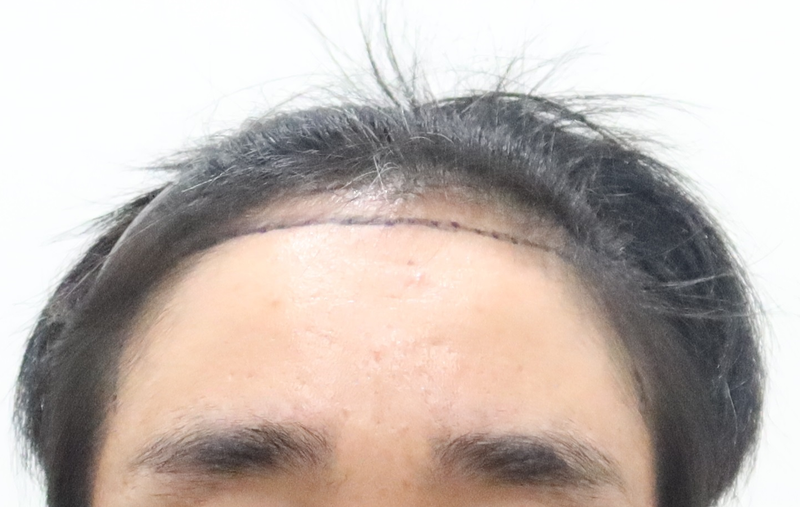 대구모모의원 2600모 비절개 222일차