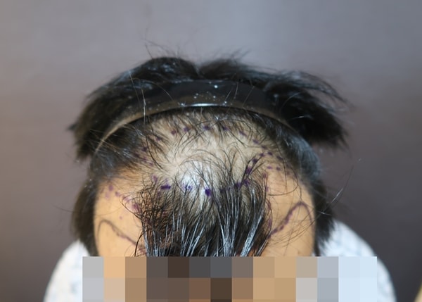 이식전.jpg