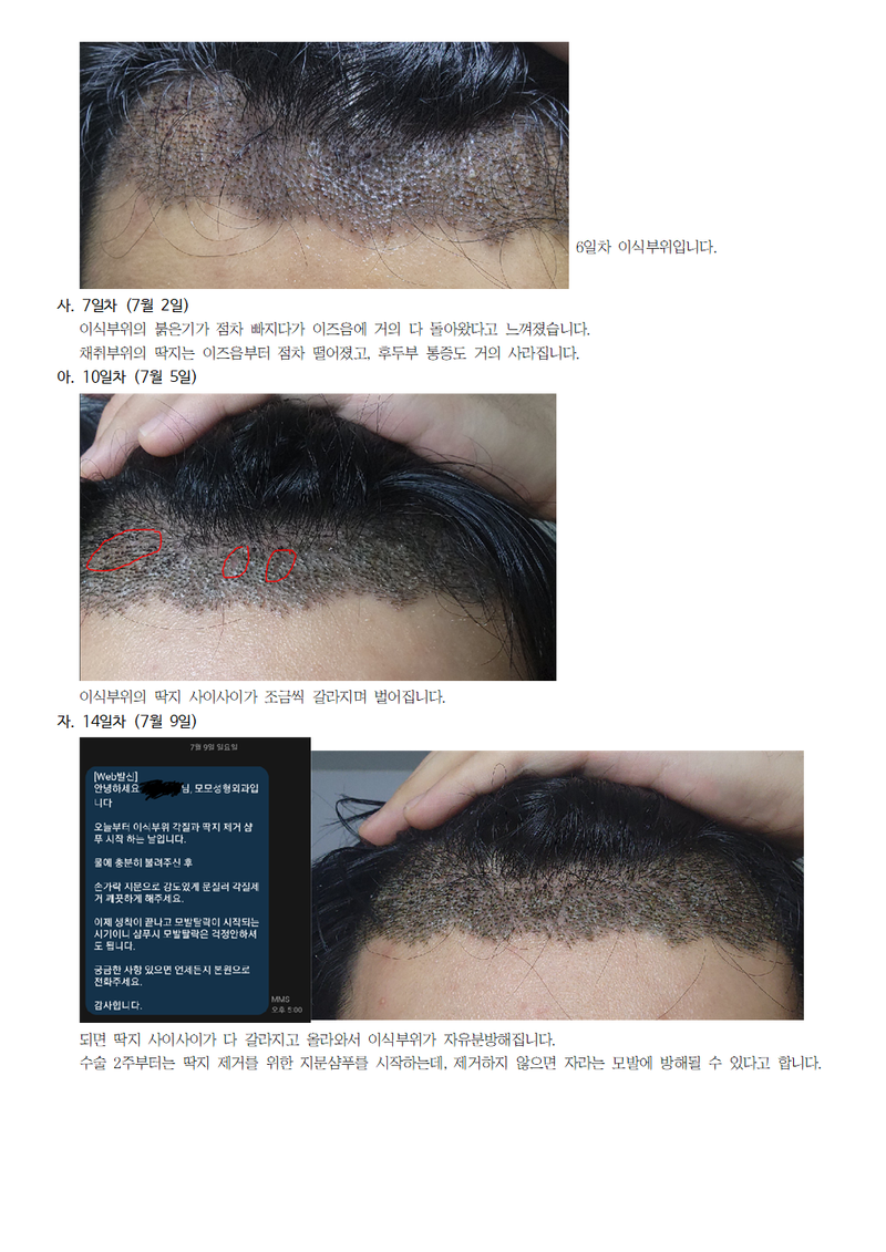 모모성형외과 모발이식 후기006.png