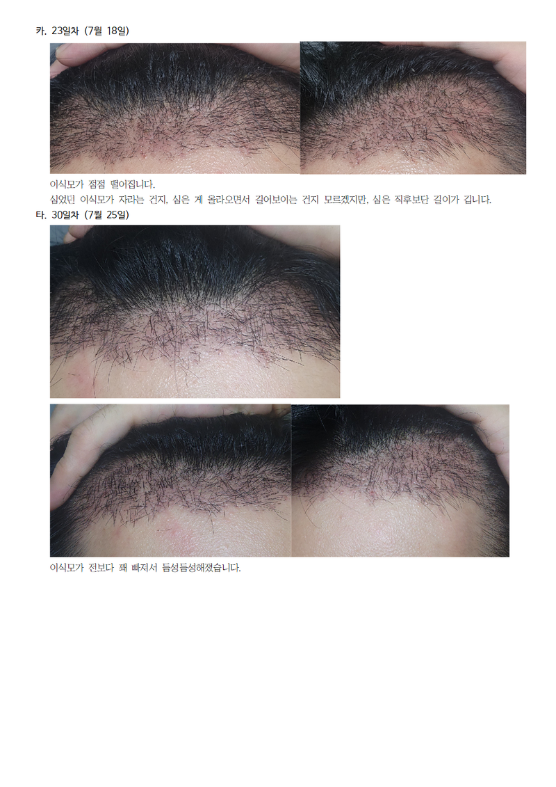모모성형외과 모발이식 후기008.png
