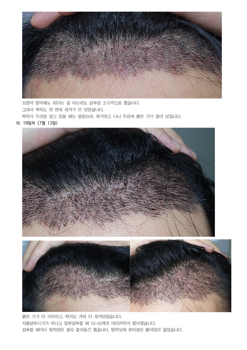 모모성형외과 모발이식 후기007.png