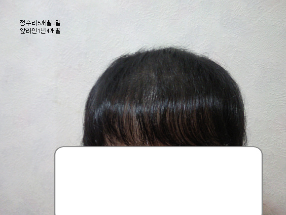 정수리5개월1.jpg