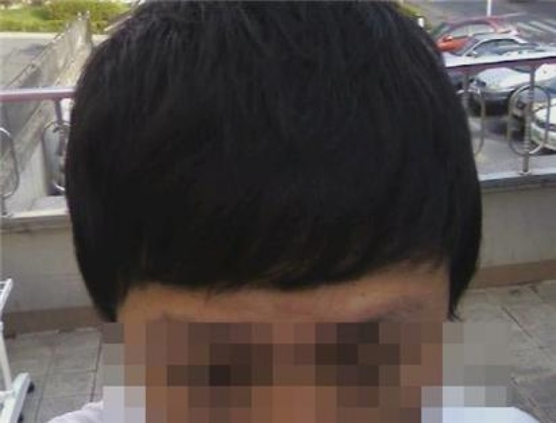 수술후3개월(2).jpg