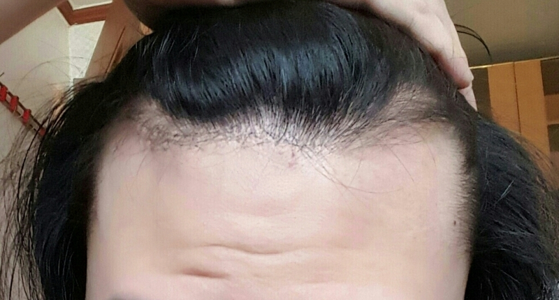 安养夏娃毛发移植切开式 3000 毛后期