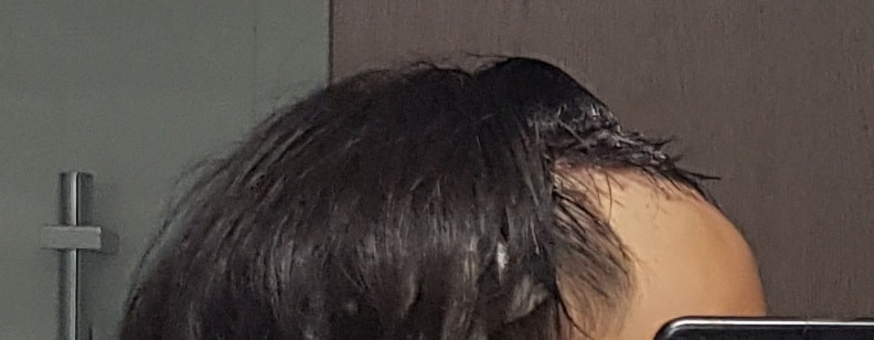 수술 후 당일6.jpg