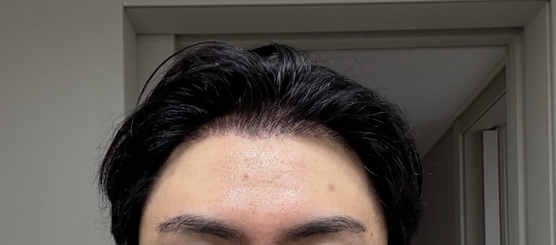 [Michelan clinic] After a hair transplant failure at another hospital, he had a correction surgery at Mikhelan clinic