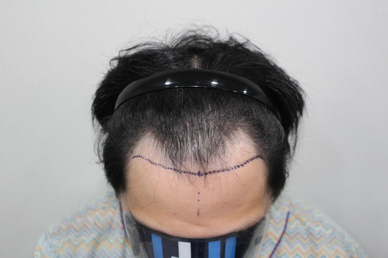 앞구정 모더함의원에서 머리 심고 왔어요!