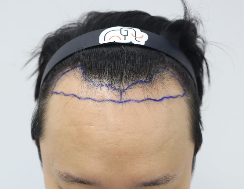 수술전.jpg
