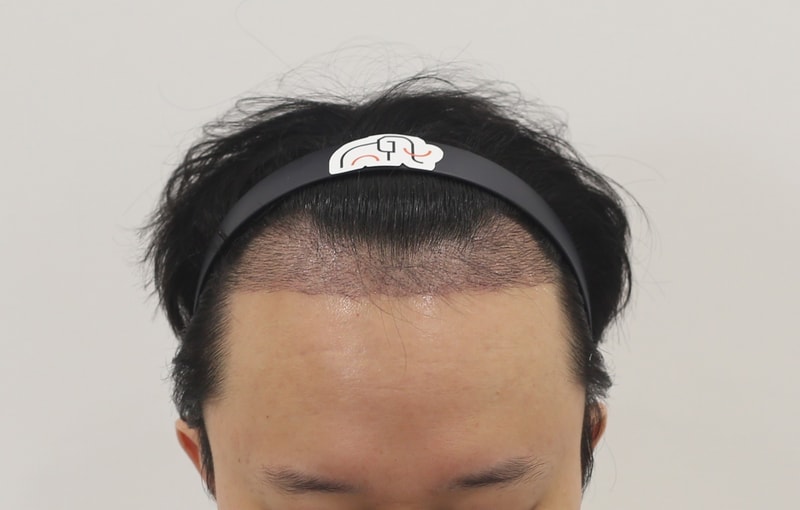 수술후 2주.jpg