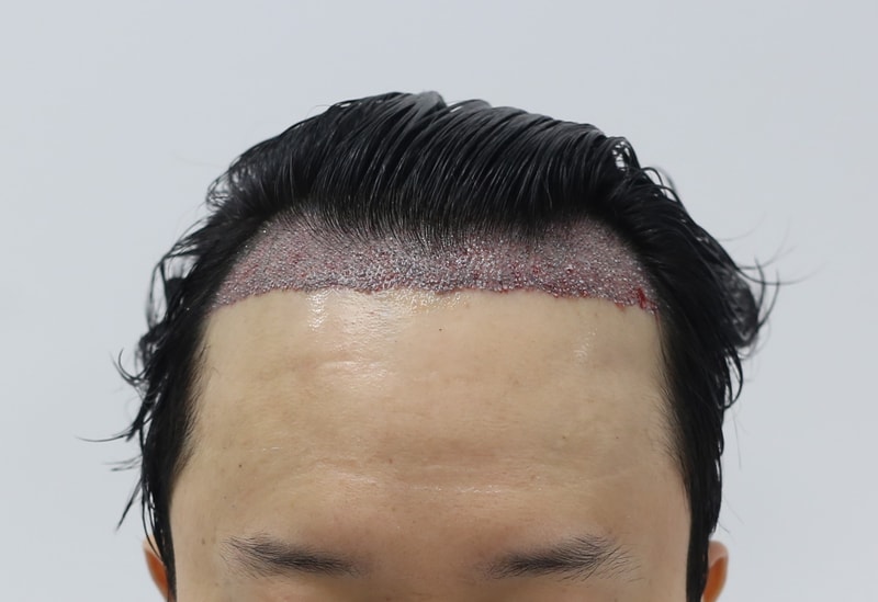 수술후.jpg