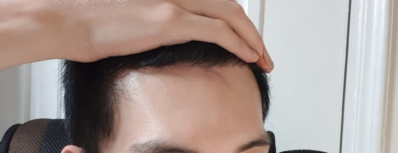 非切開毛髪移植1年経過満足~