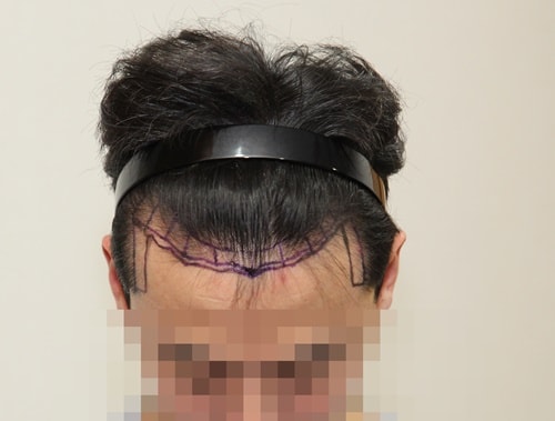 留下11个月M字移植1700毛囊后期。 怎么样
