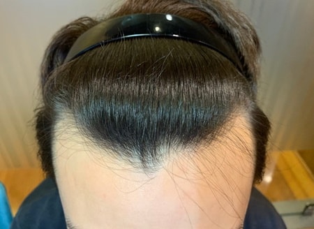 9th month~ Review of 3,200 hair incision record