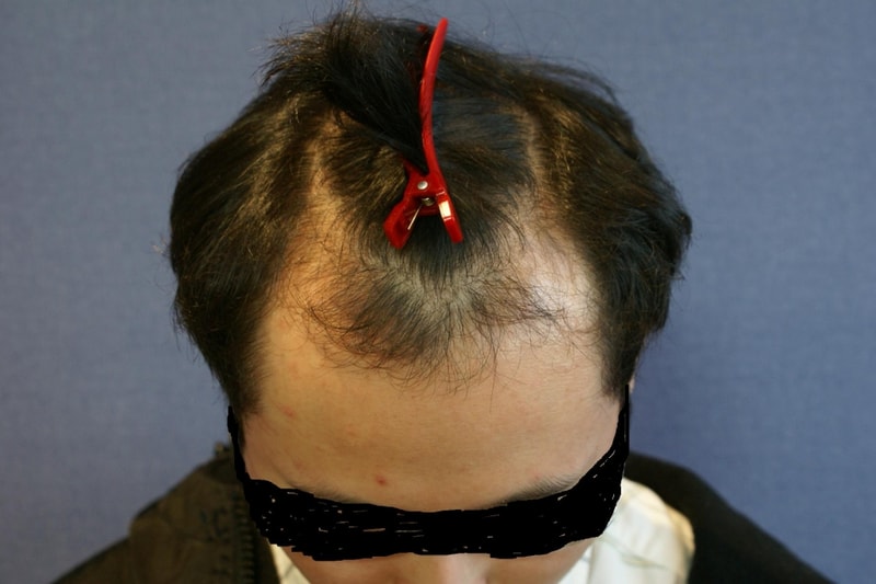수술전모델.JPG