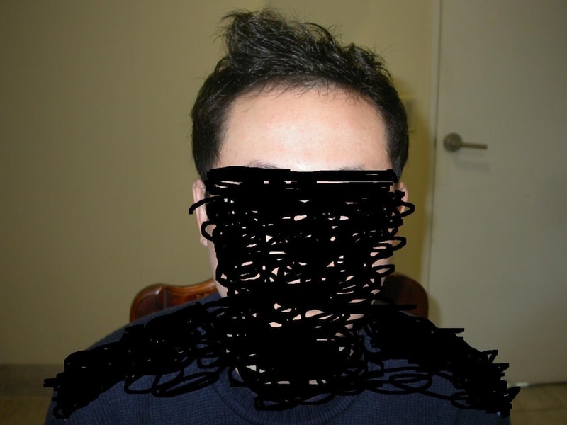 크기변환_수술전머리상태.JPG