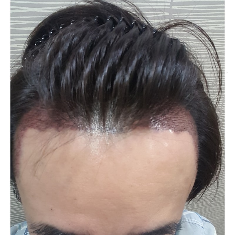 수술1일후.jpg