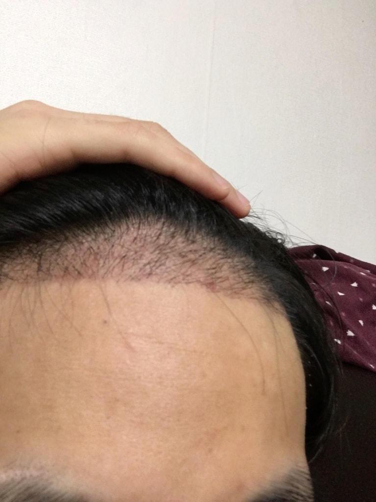 두피사진.jpg