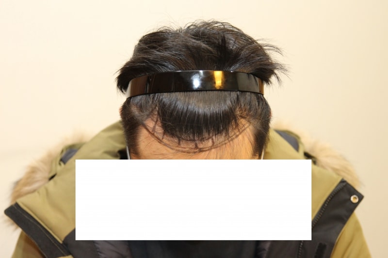 1년 수술 후기