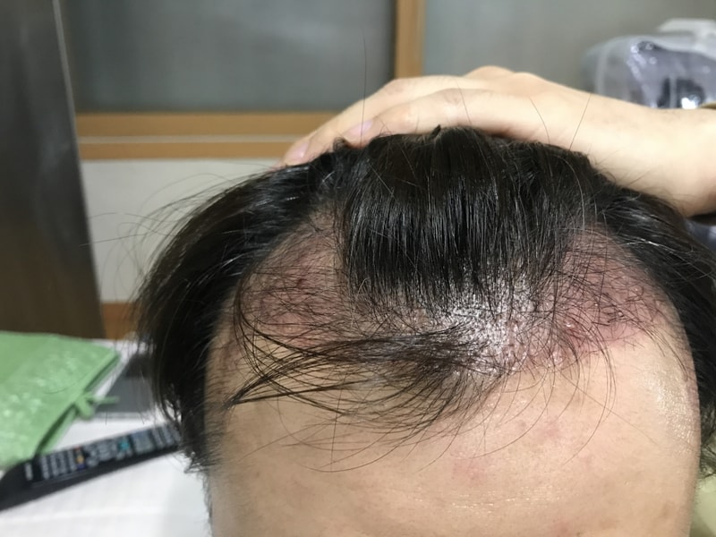 9월 16일 모발이식 1달 후 평가
