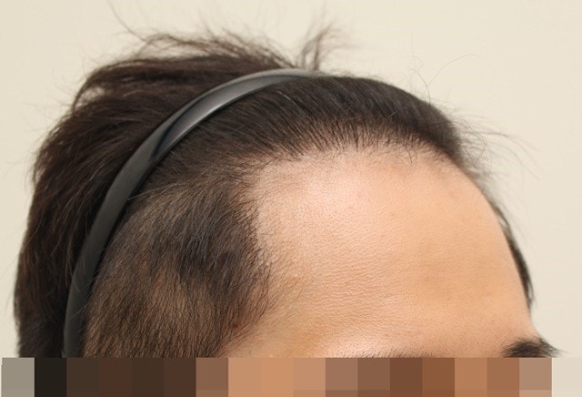 수술후 2.jpg