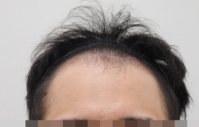 I'm in my mid-30s and it's been a year since I transplanted.