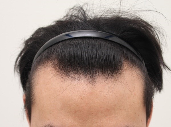 수술전, 1개월, 3개월 비교사진