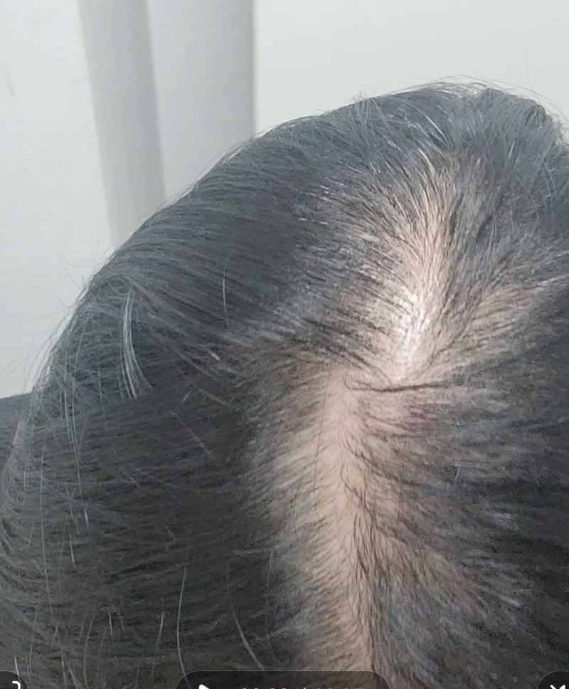 40대후반 모발이식  7개월차 골룸동반탈후 조금 회복 수술전으로 회복 못함