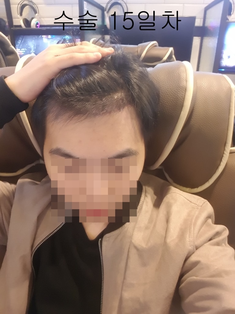 수술15일차2.jpg