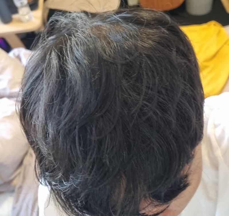 Parental Hair Transplantation Center Forehead 1500 Hair follicles (12 Months) Review