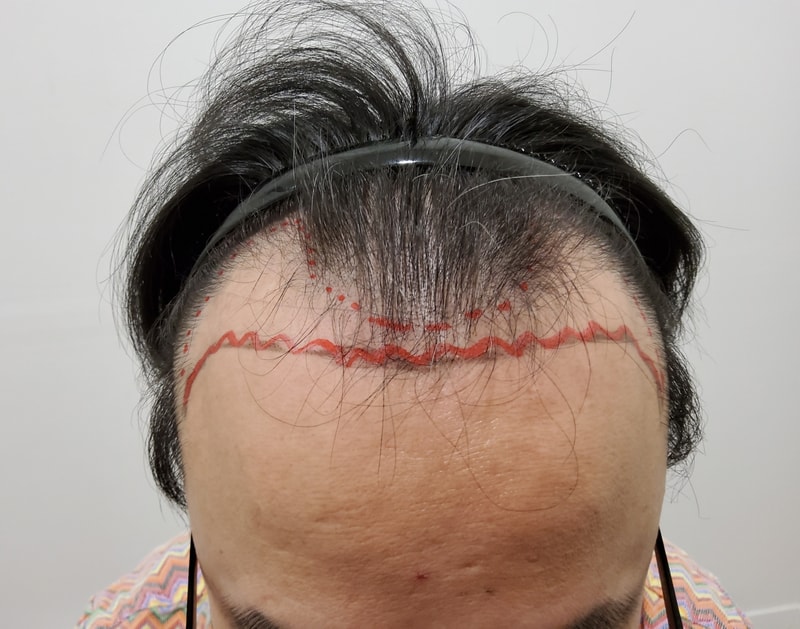 I'm here to leave a review of non-cut hair transplantation.