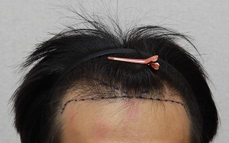 いつの間にか毛髪移植6ヶ月目です。