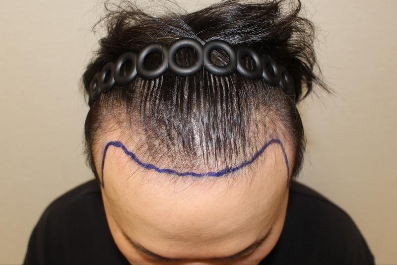 Modaol Hong Jun-hyun, the first day of incisional hair transplantation