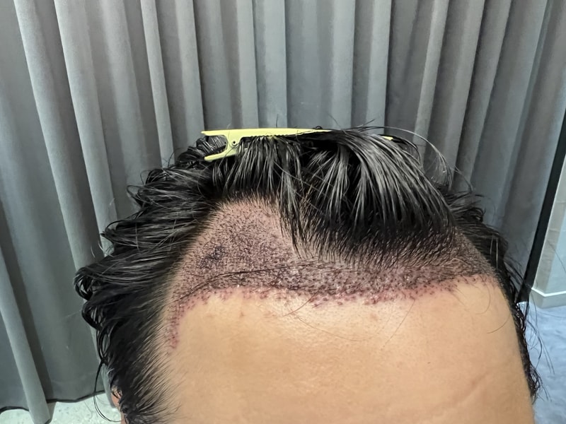 1. 수술후_1일_1.jpg