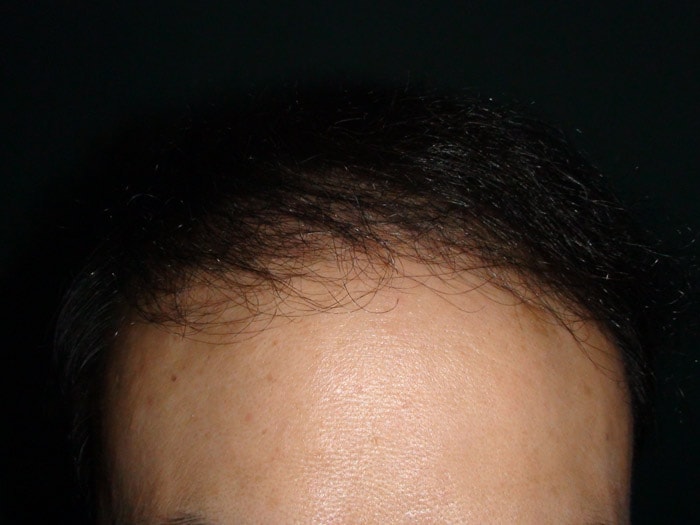 준섭,술후,정면,s.jpg