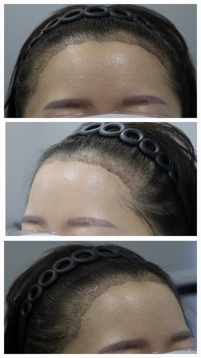 대구 헤어로의원 14일차 모발이식 후기